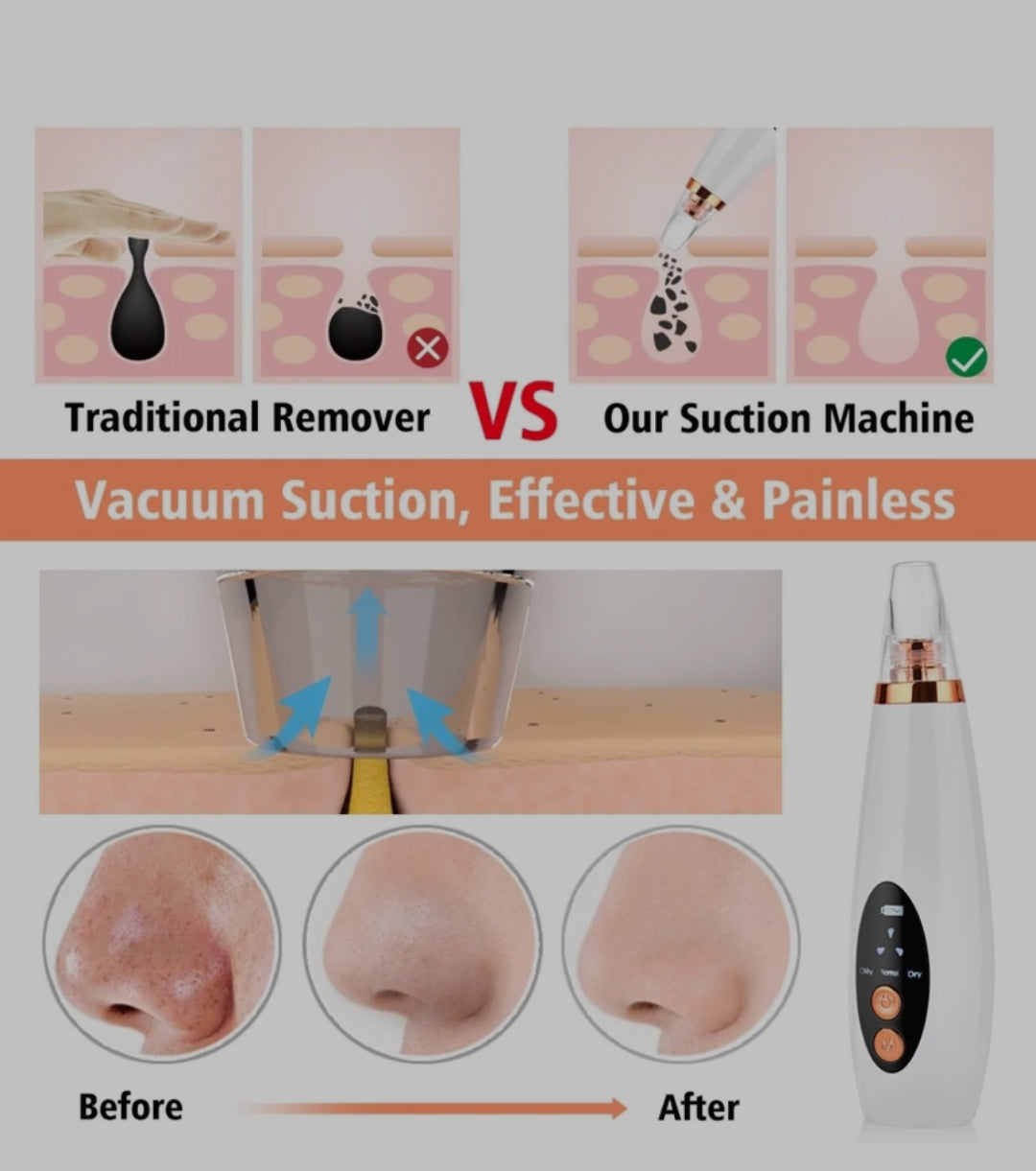 Blackhead remover